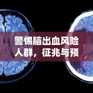 警惕脑出血风险人群，征兆与预防全解析！